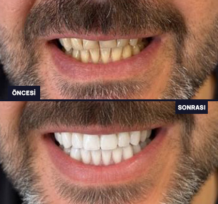 AI Gülüş Tasarımı - Önce ve Sonra