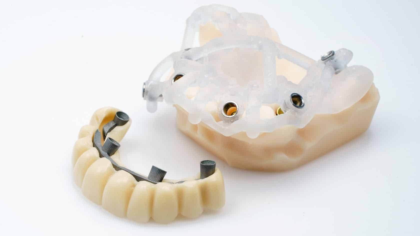 All on Four implant