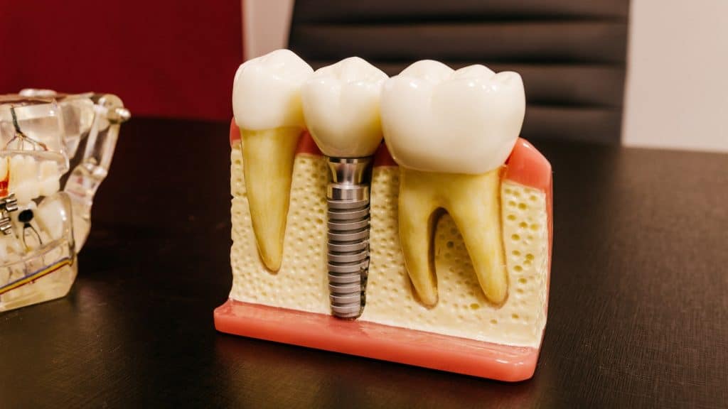 implant diş