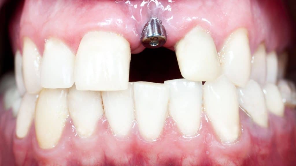 implant yan etkileri