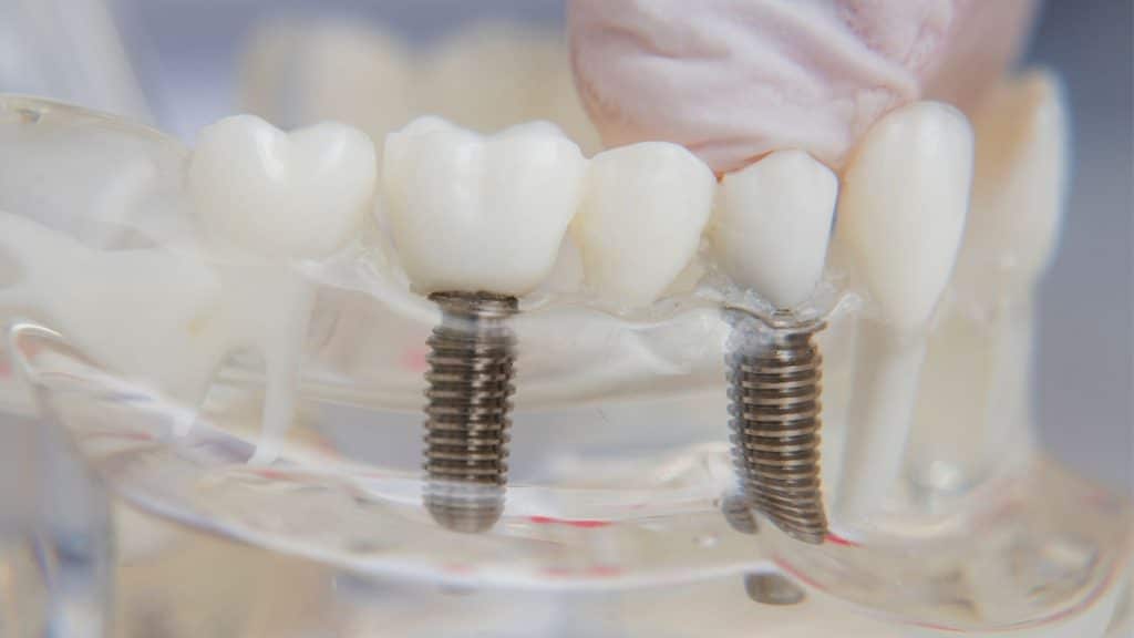 implant