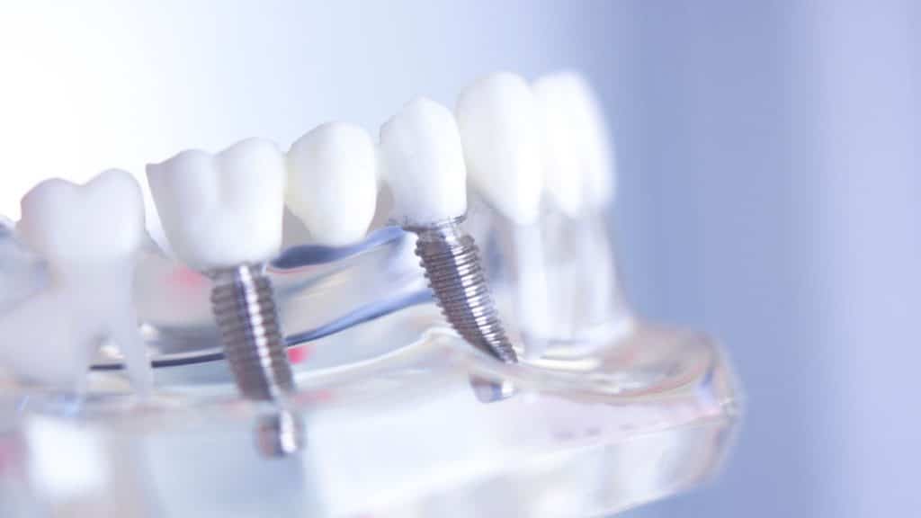 implant