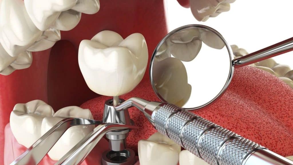 implant tedavi süreci