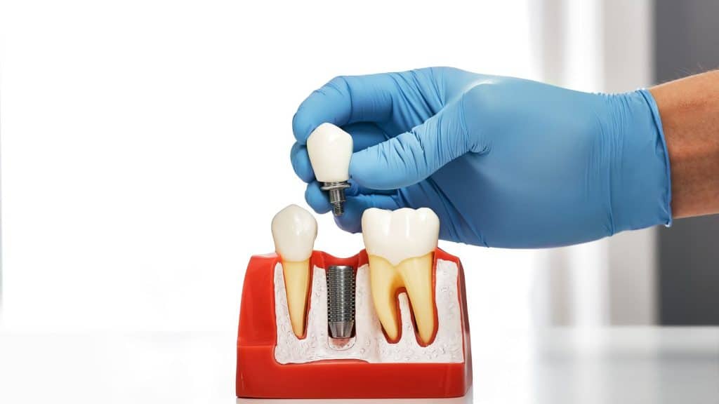 implant tedavi süreci